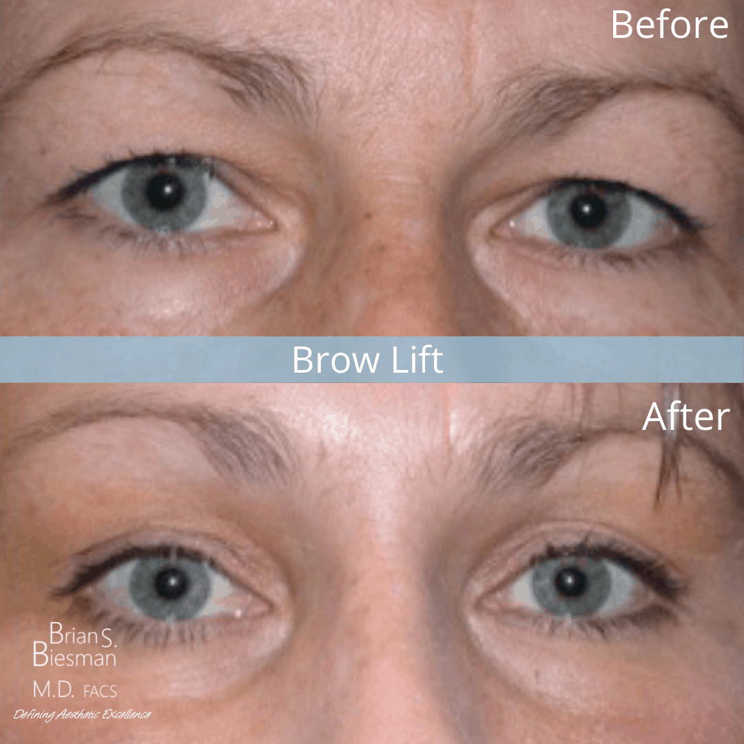Perfect Bedrijfsomschrijving Hobart Blepharoplasty vs. Brow Lift: Which is Best for Sagging Eyelids? - Brian  Biesman MD