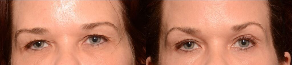 Botox Treatment to Lift the Brows