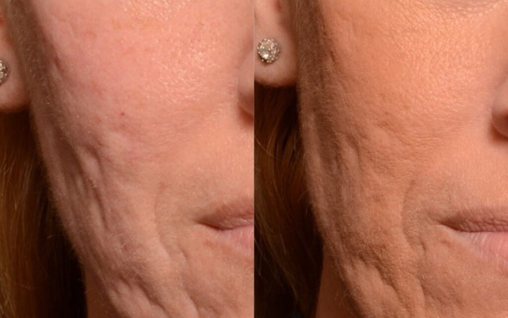 Subcision of Acne Scars post 1 tx - Results & ©Brian S. Biesman, M.D.