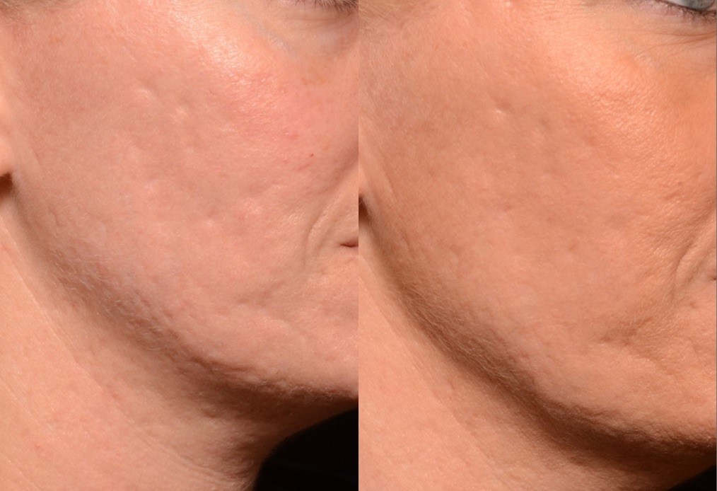 Subcision of Acne Scars post 1 tx - Results & ©Brian S. Biesman, M.D.