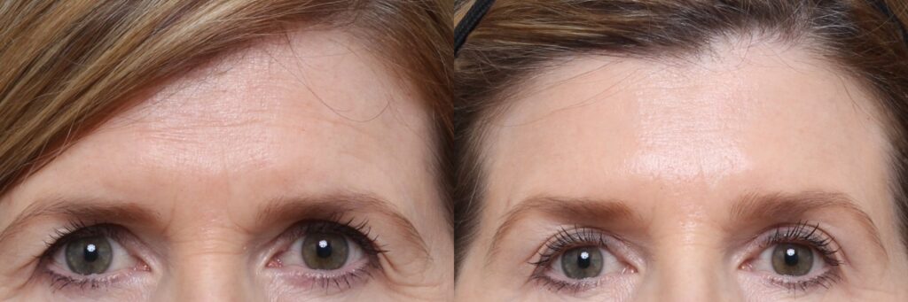 Botox Treatment of Glabella & Brows Results