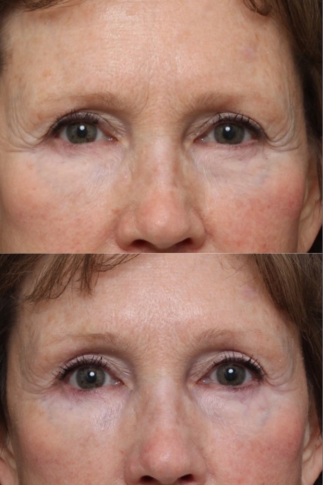 Botox Treatment of the Brows Nashville