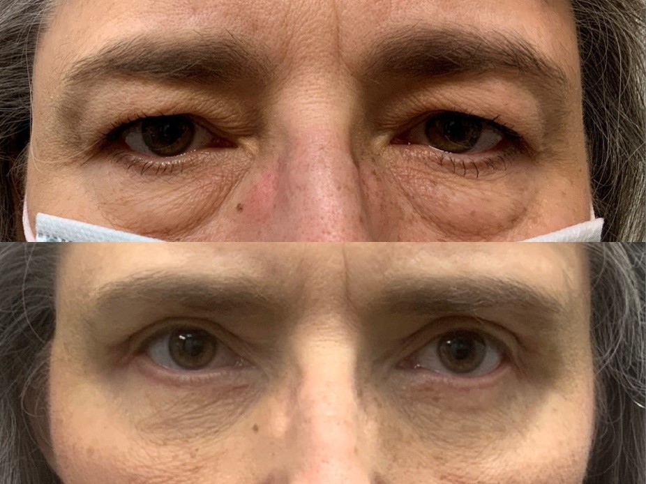 Bilateral Upper and Lower Lid Blepharoplasty & Endoscopic Brow Lifting - Results & ©Brian S. Biesman, M.D.