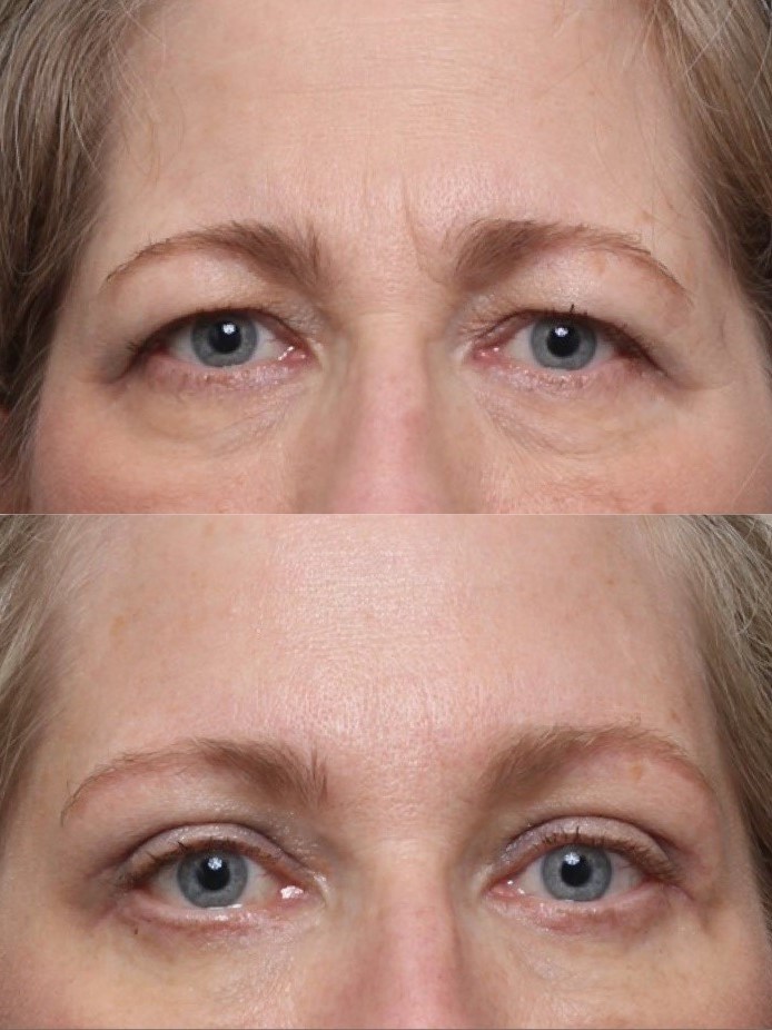 Bilateral Upper & Lower Lid Blepharoplasty & Endoscopic Brow Lifting 2
