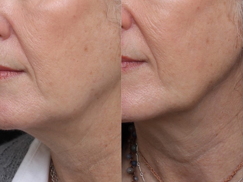 Lower Face Ultherapy