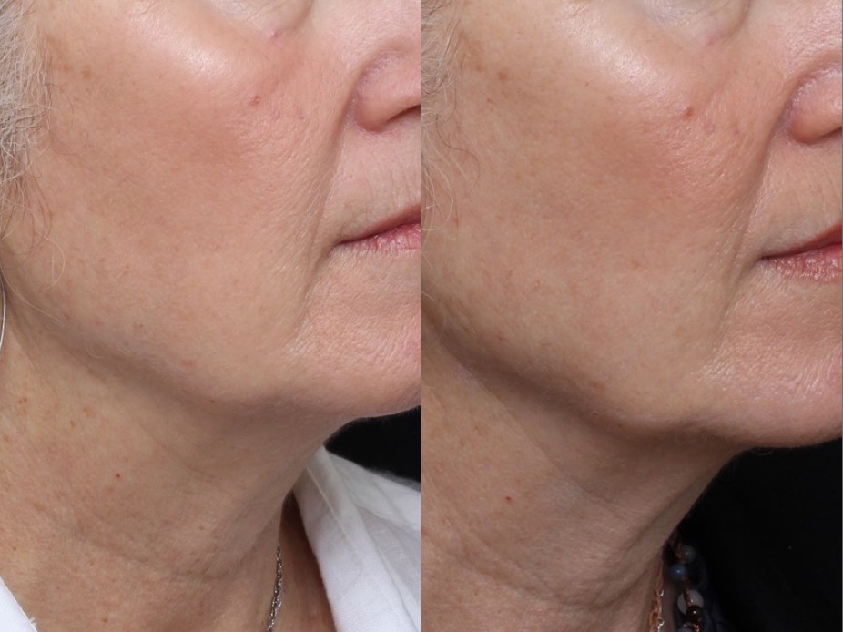 Lower Face Ultherapy Results