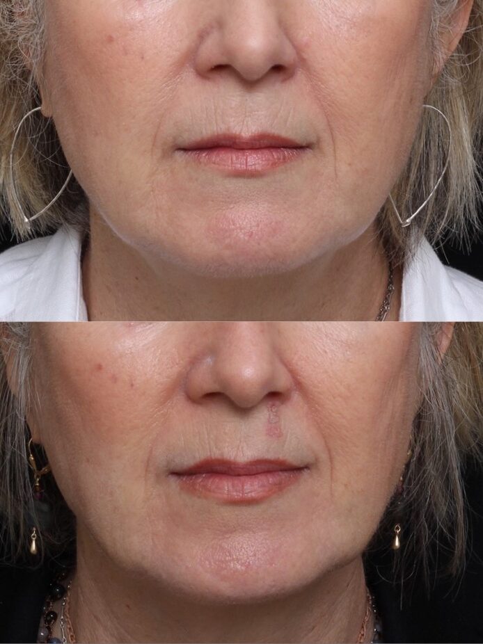 Lower Face Ultherapy Result