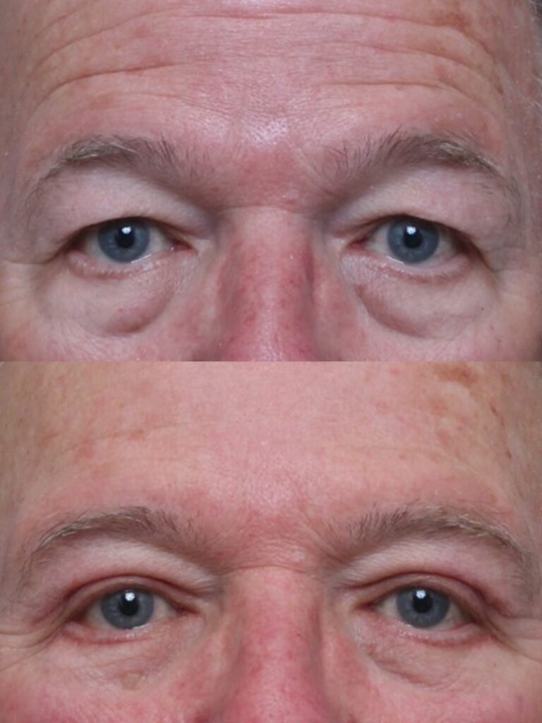 Bilateral Upper and Lower Lid Blepharoplasty & Brow Pexy