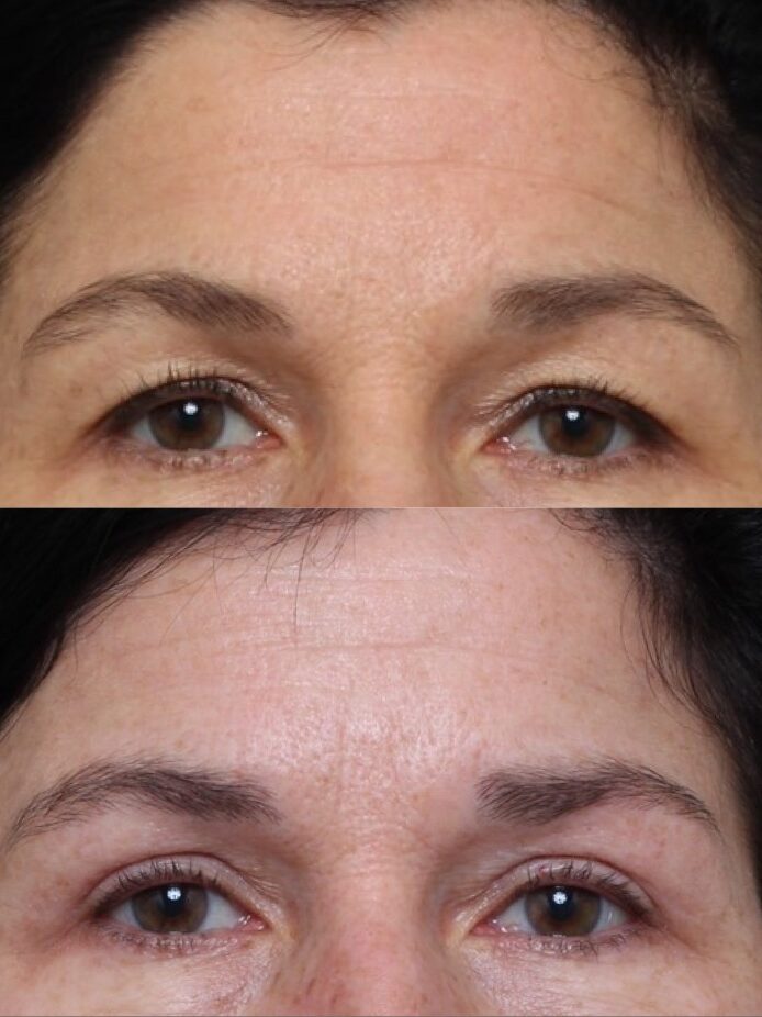 Bilateral Upper Lid Blepharoplasty and Brow Pexy