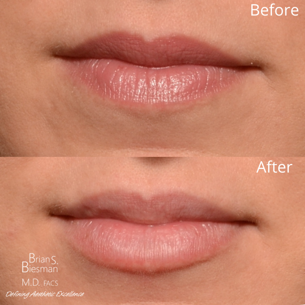 Lip injections - Results & ©Brian S. Biesman, M.D.