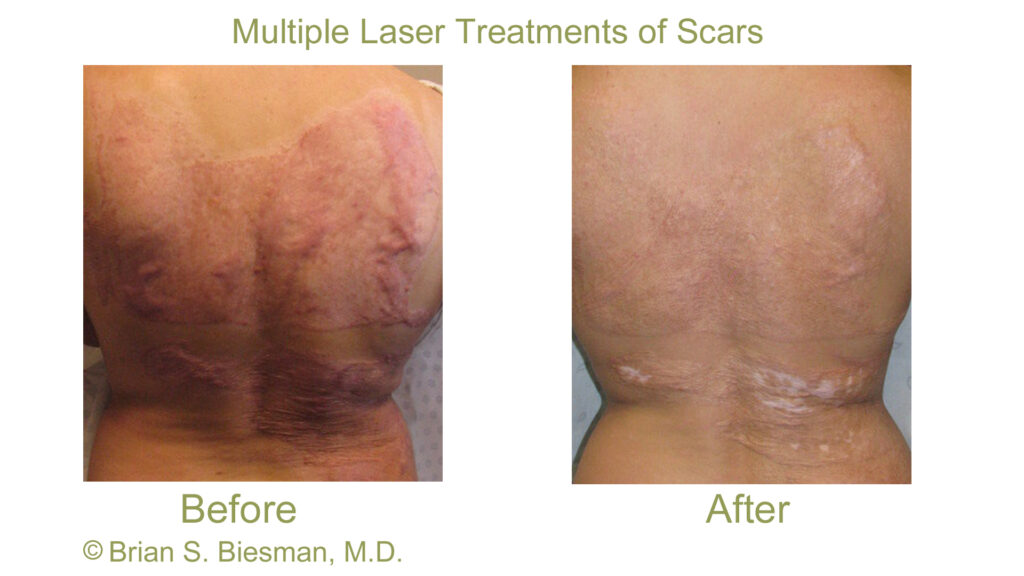 Multiple Laser Treatments to Chemical Burn Scars