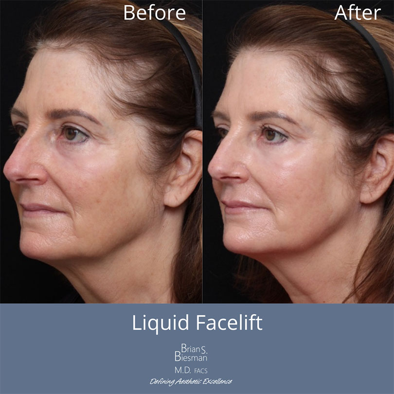 liquid facelift nashville Before and After