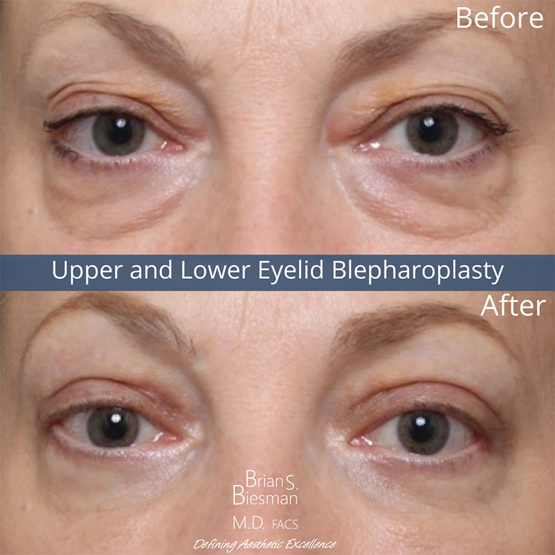 Blepharoplasty Nashville Before and After