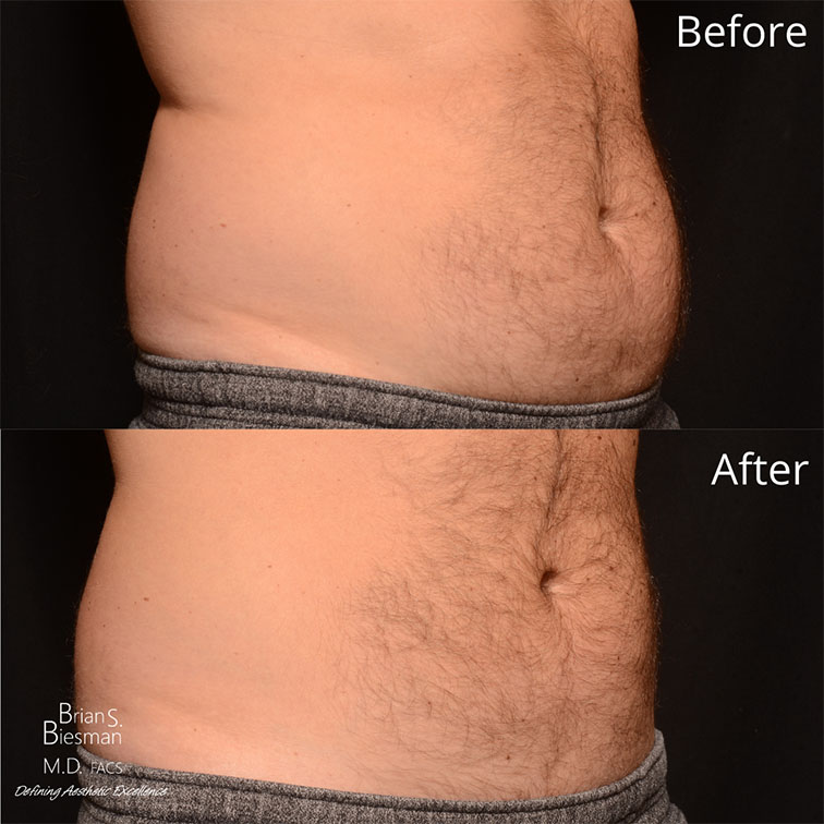 CoolSculpting Nashville Before and After