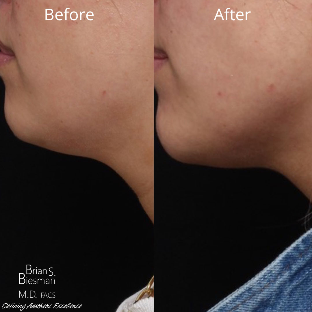 Kybella Double Chin Before and After Photo