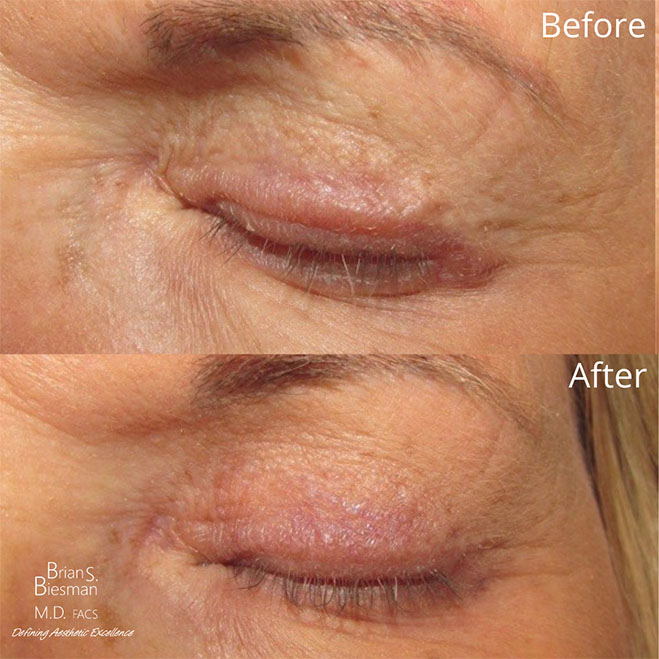 Treatment of Scarring Before and After Photo Nashville, TN