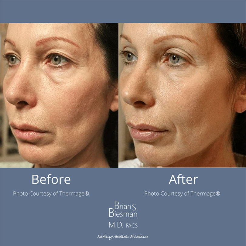 Thermage Noninvasive Skin Tightening Before and After Photo Nashville, TN