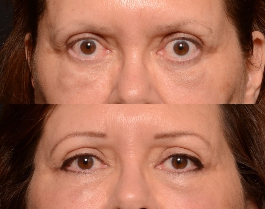 Bilateral Lower Lid Retraction Correction