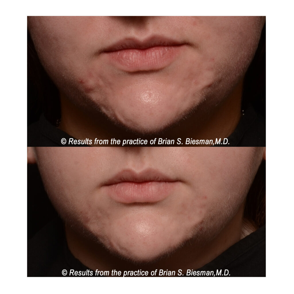 Chin Acne Scars Subcision