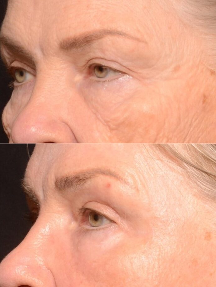Full Face Full Ablative Fractional Laser Skin Resurfacing Treatement -Results & © Brian S. Biesman, M.D.