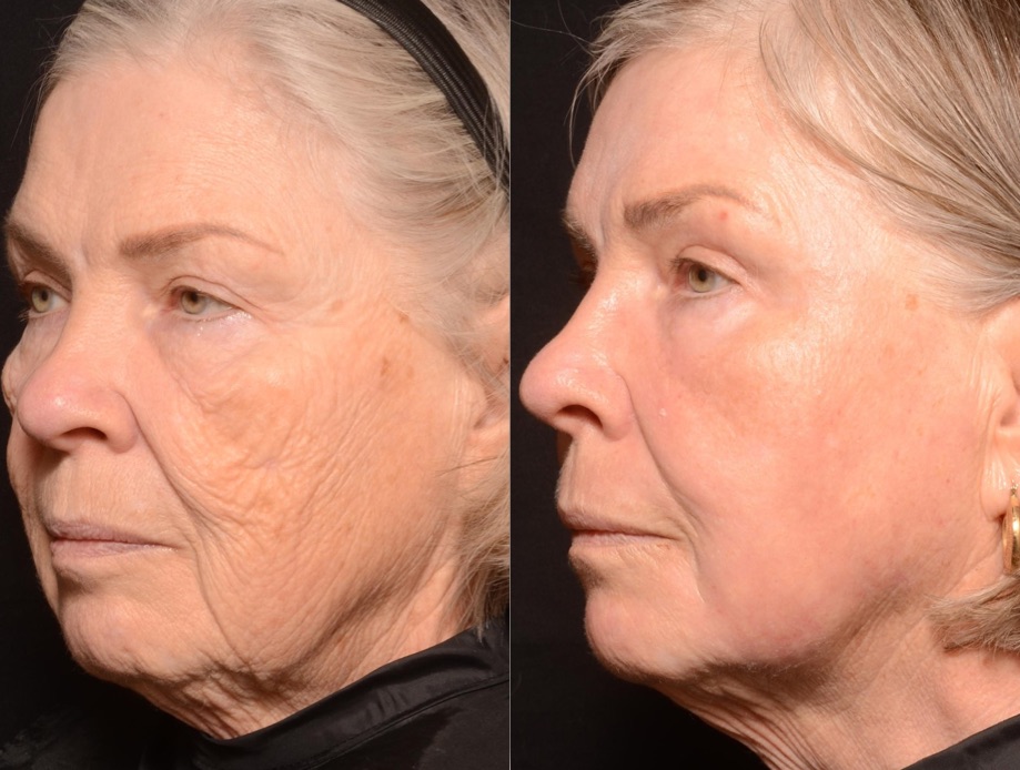 Full Ablative Fractional Laser Skin Resurfacing Treatement -Results & © Brian S. Biesman, M.D.