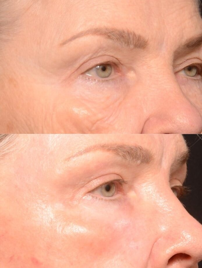 Full Ablative Fractional Laser Skin Resurfacing Treatment