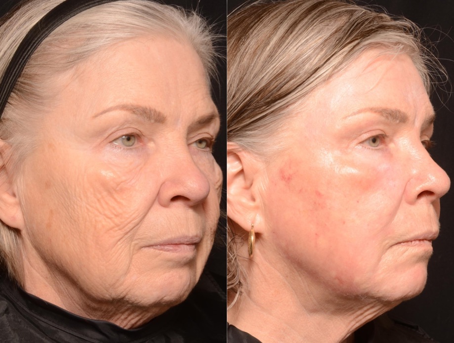 Full Face Full Ablative Fractional Laser Skin Resurfacing