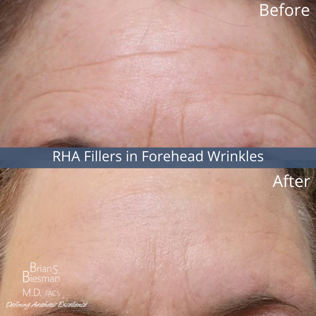 RHA Fillers in Forehead Wrinkles