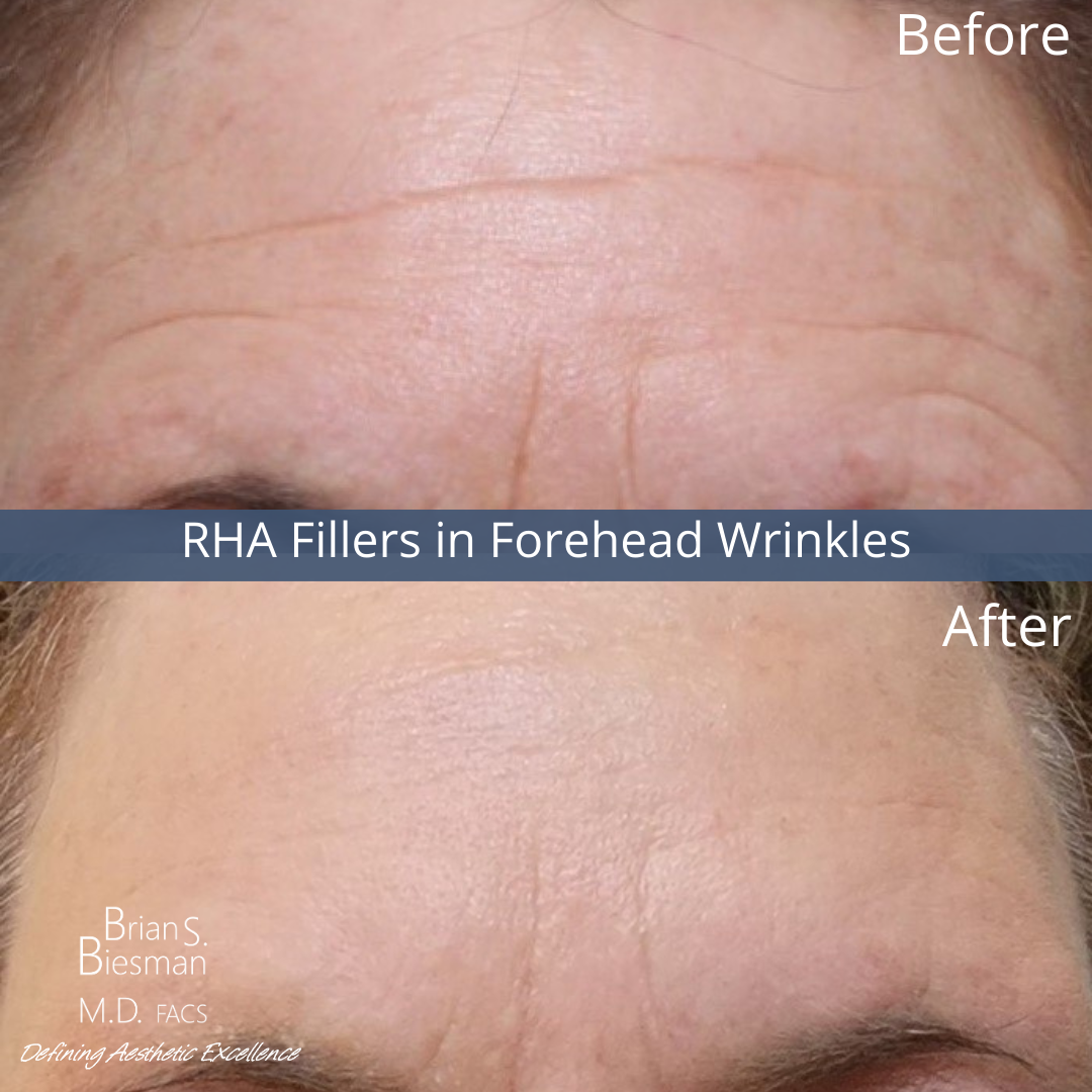 RHA Filler Before and After