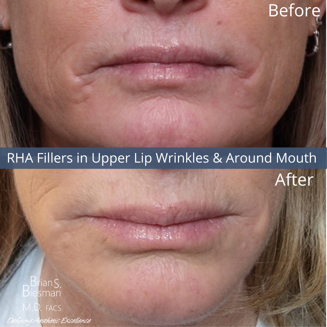 Injectable Fillers Before and After