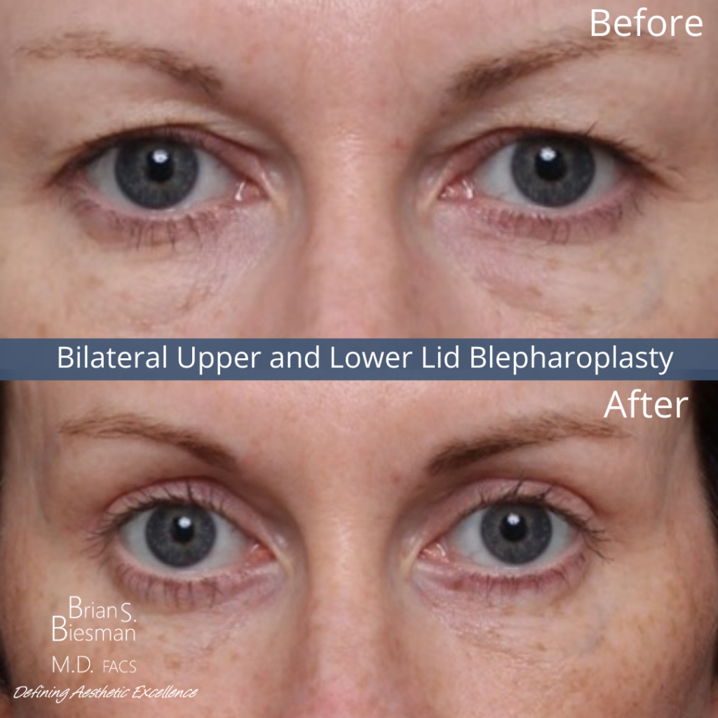 Bilateral Upper Lower Lid Blepharoplasty Results nashville