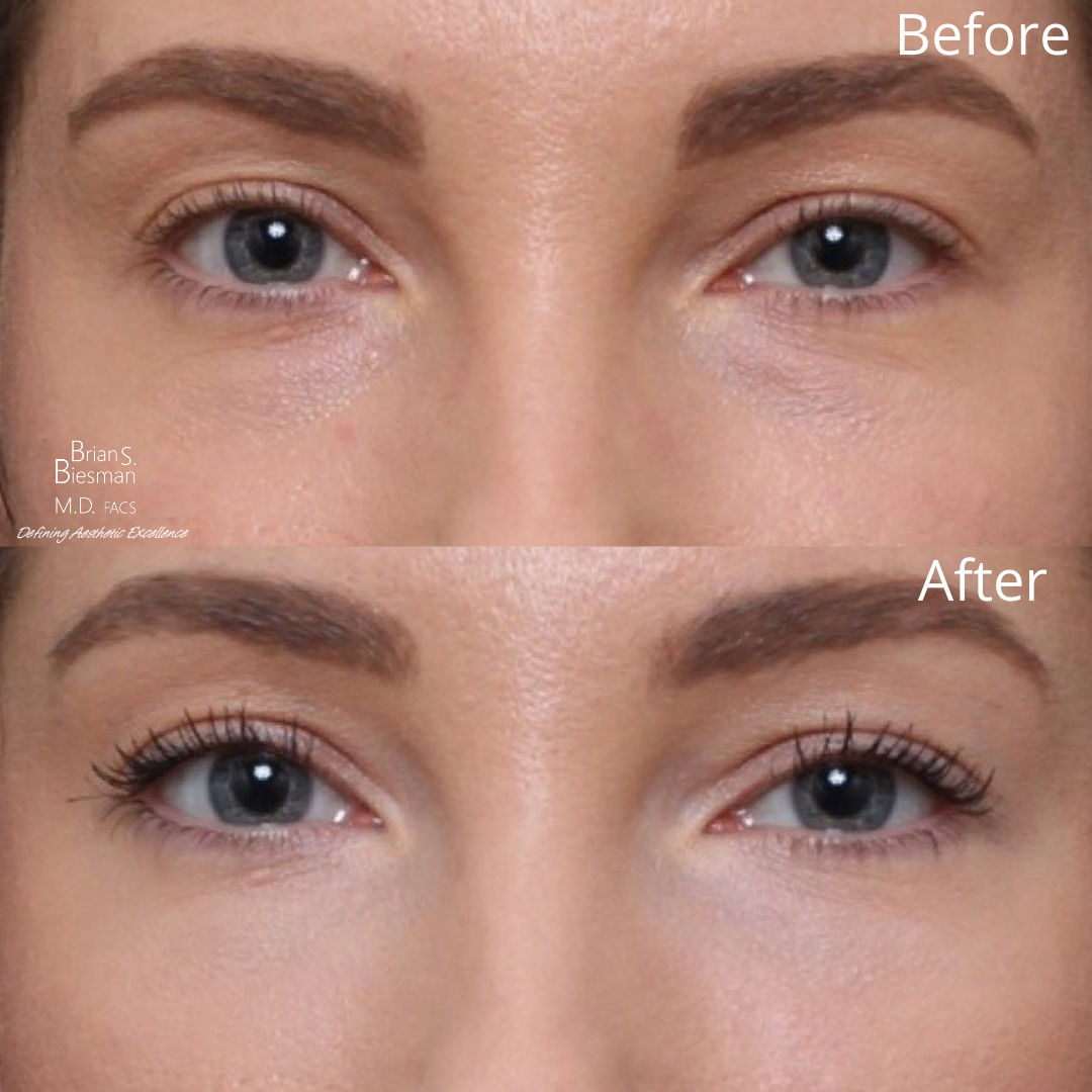 Juvederm Volbella XC Before and After Nashville