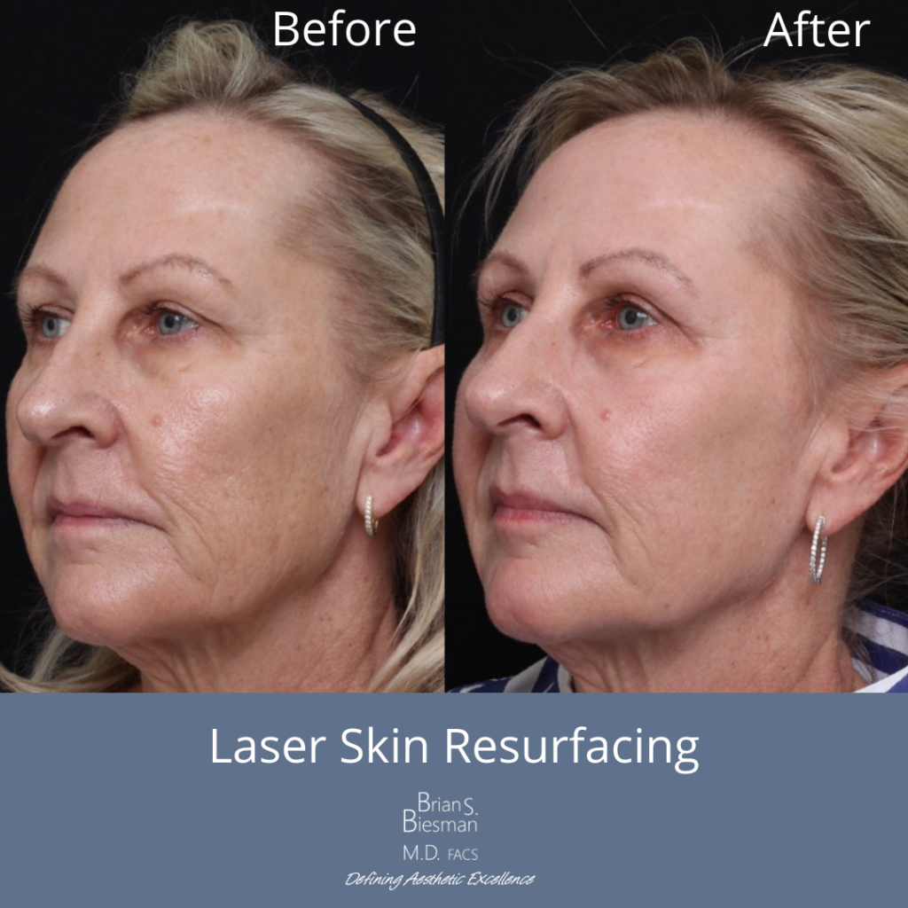 UltraClear Laser Skin Resurfacing
