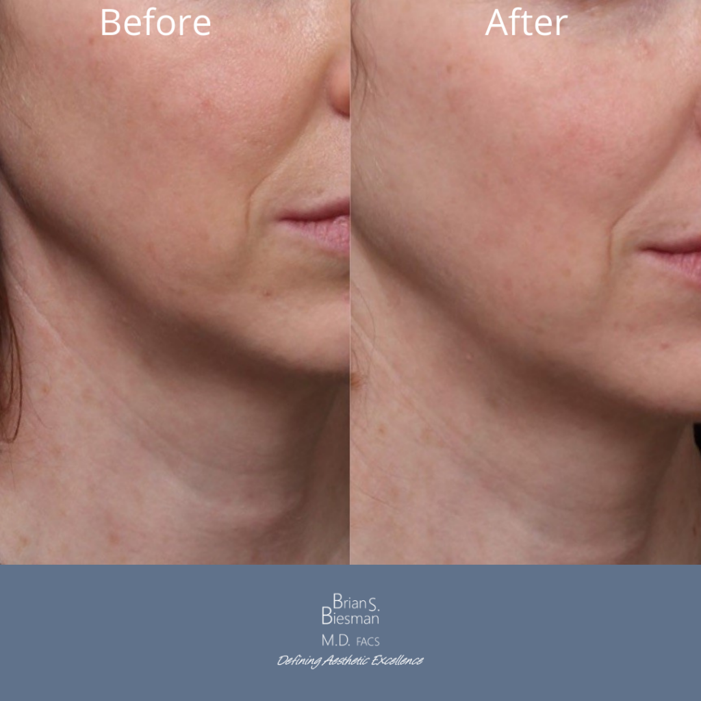 Jawline Contouring with Botox