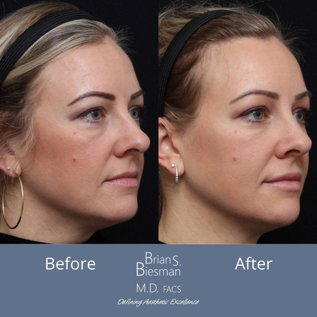 Injectable Fillers Before and After Nashville, TN
