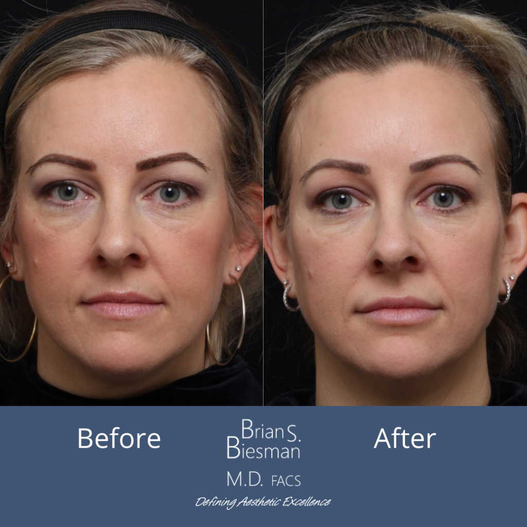 Injectable Face Lift Before and After