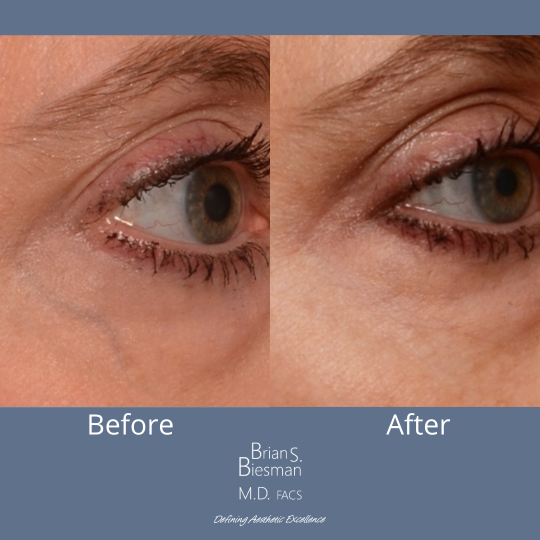 Before and After eyelid vein