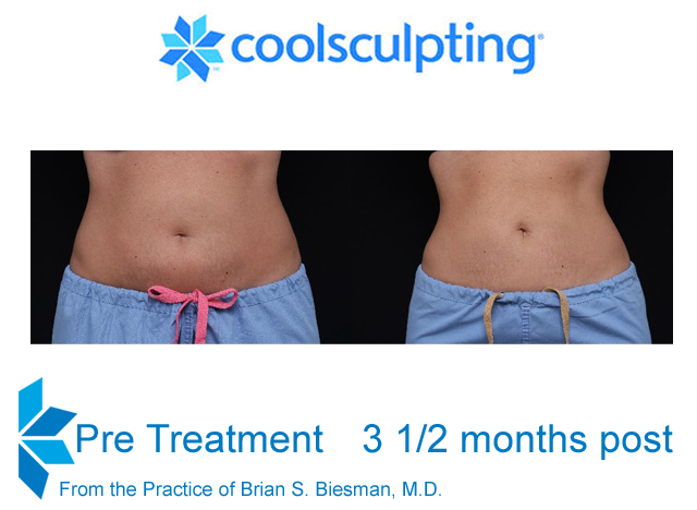 Cool Sculpting Non Invasive Fat Reduction - Results