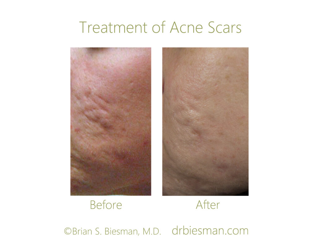 Subcision and Excision of Acne Scars