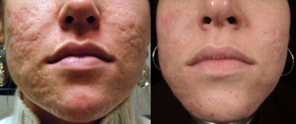Subcision & Excision of Acne Scars