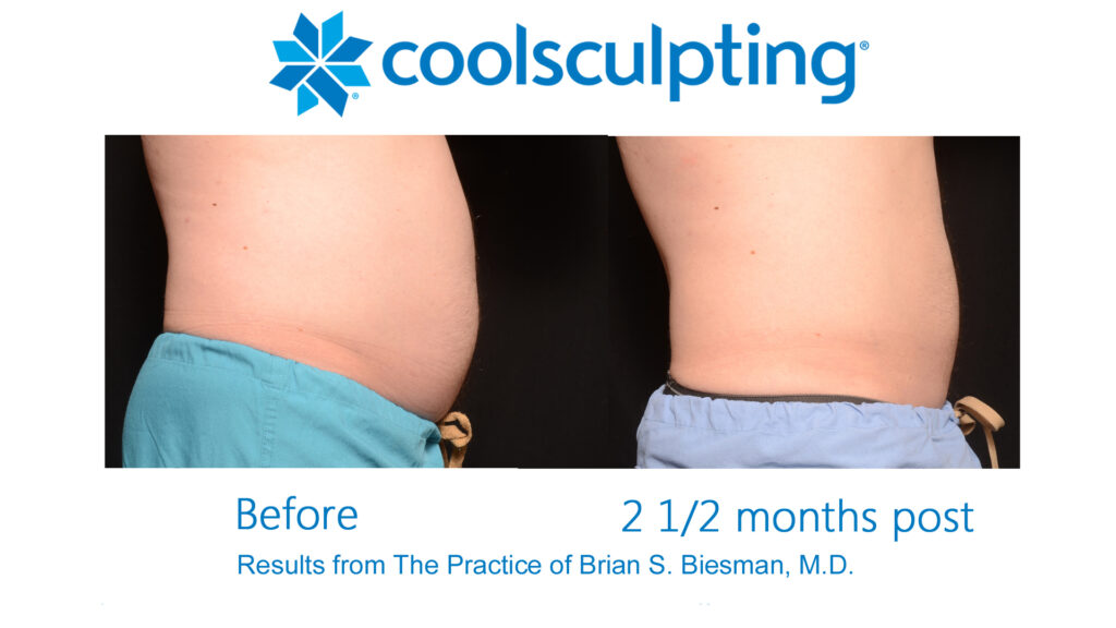 CoolSculpting Non Invasive Fat Reduction - Results & © Brian S. Biesman, M.D