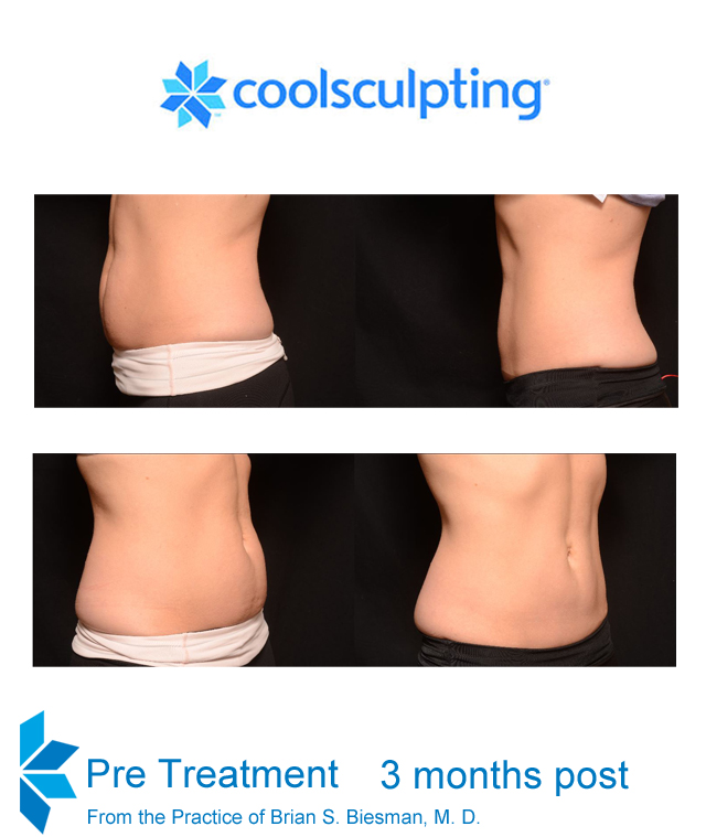 CoolSculpting