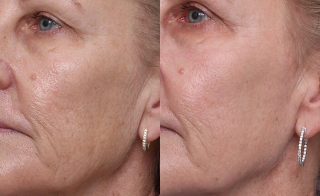 Before and After UltraGlow Factor