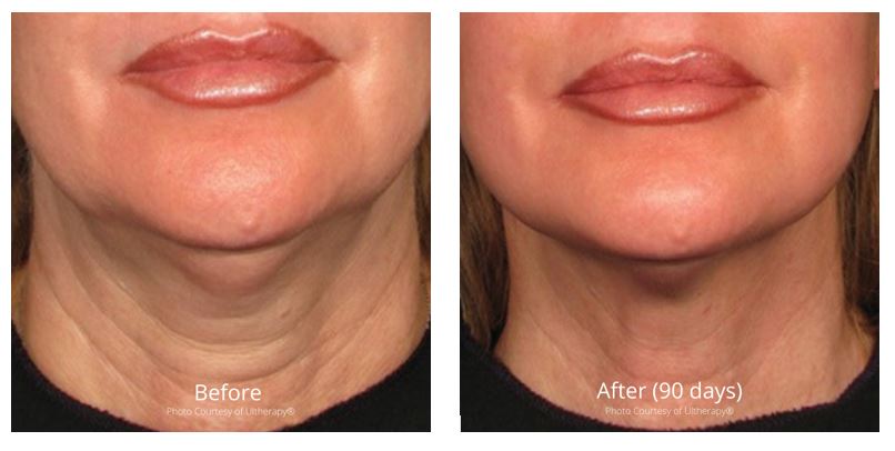 Ultherapy before and after