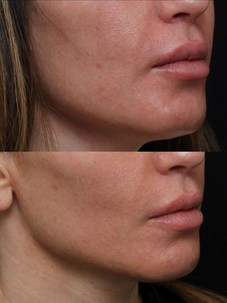 Thermage Before and After