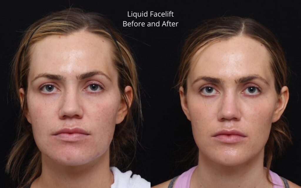 liquid facelift nashville