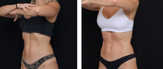 pure impact abdomen Nashville