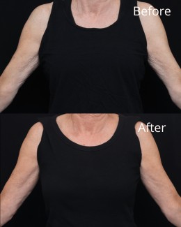 Sofwave Nashville Before and After image