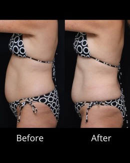 Before and After Sofwave Nashville